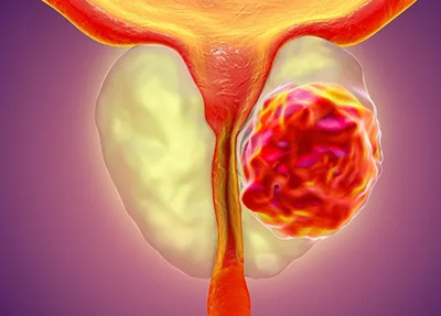 prostate-cancer 1